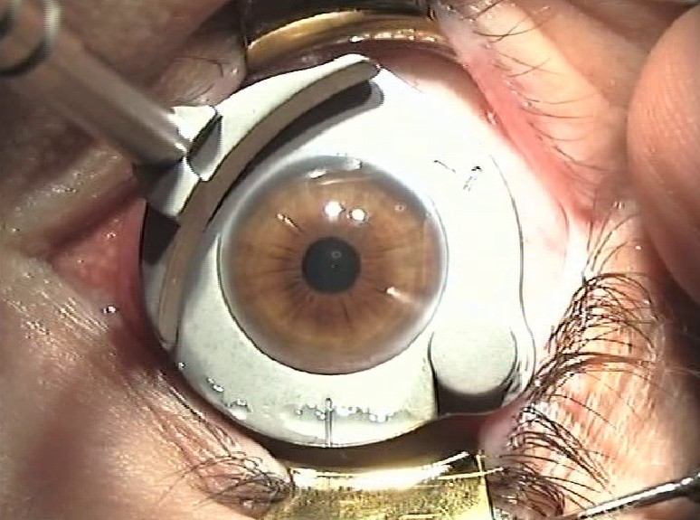 Lasik Microcheratomo